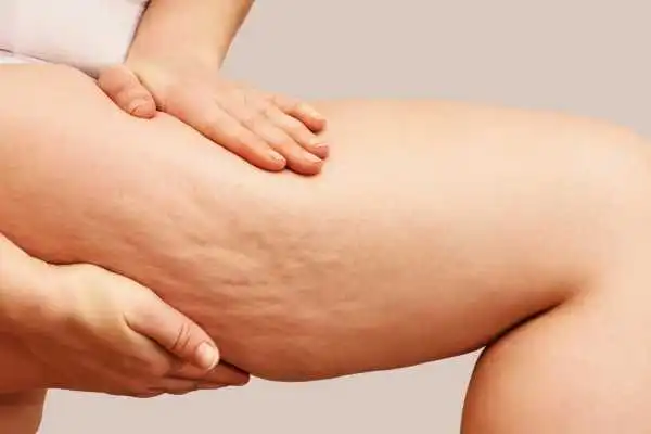 Image of woman showing leg with cellulite Blandford Camp