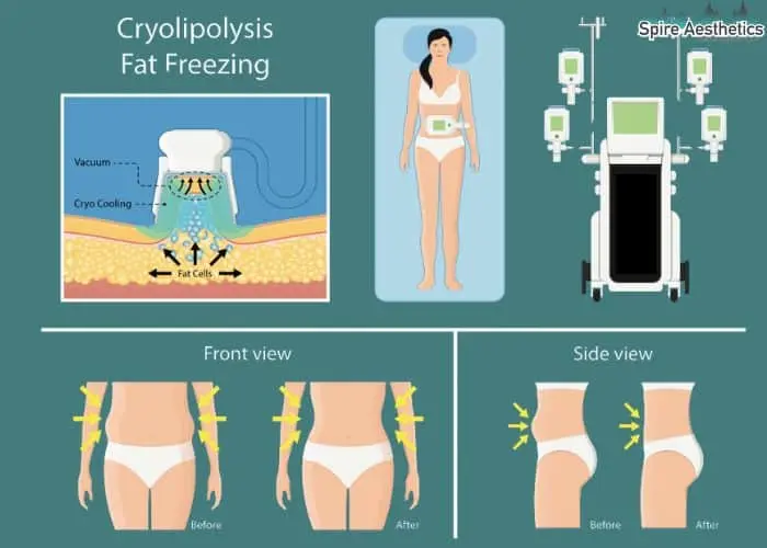 Fat freezing treatment Blandford Camp benefits for competitions to remove stubborn fat deposits.