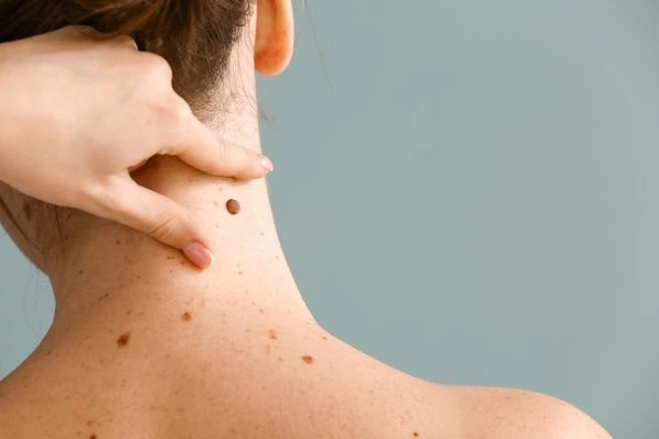 skin blemish removal Blandford Camp treatment